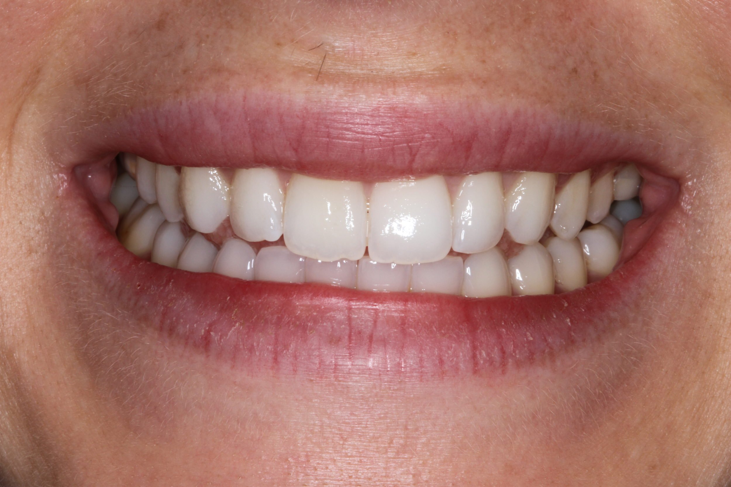 enlighten whitening results