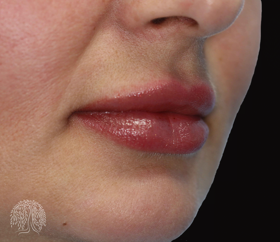 Lip Filler Treatment Lip Enhancement London NW3