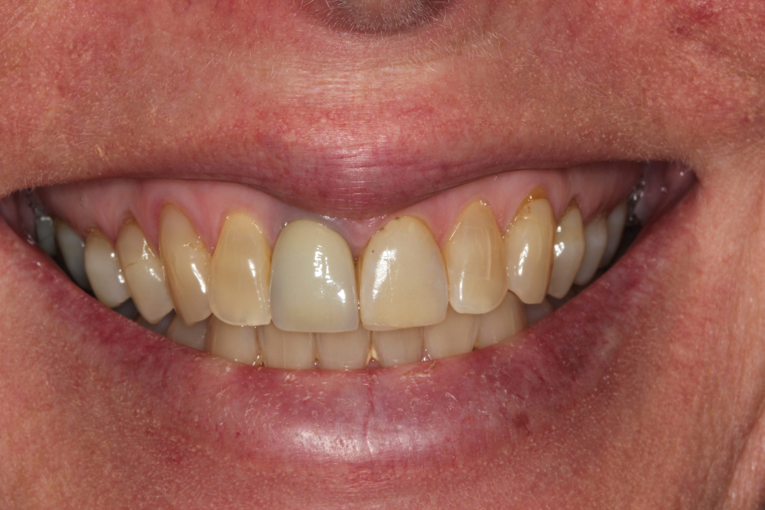 veneer change teeth whitening