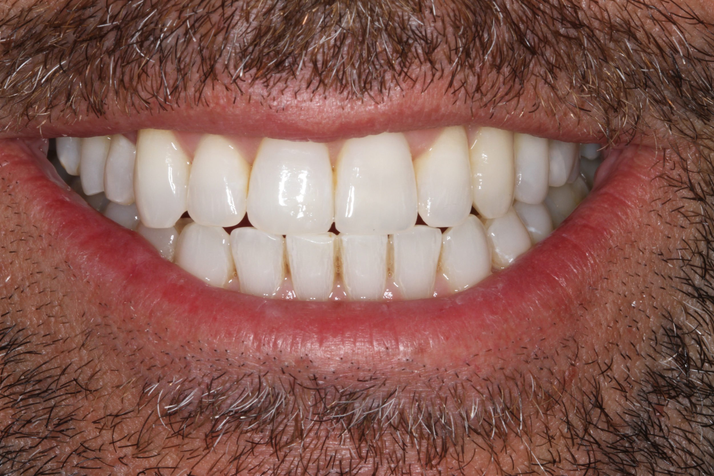 Accelebrite teeth whitening reviews