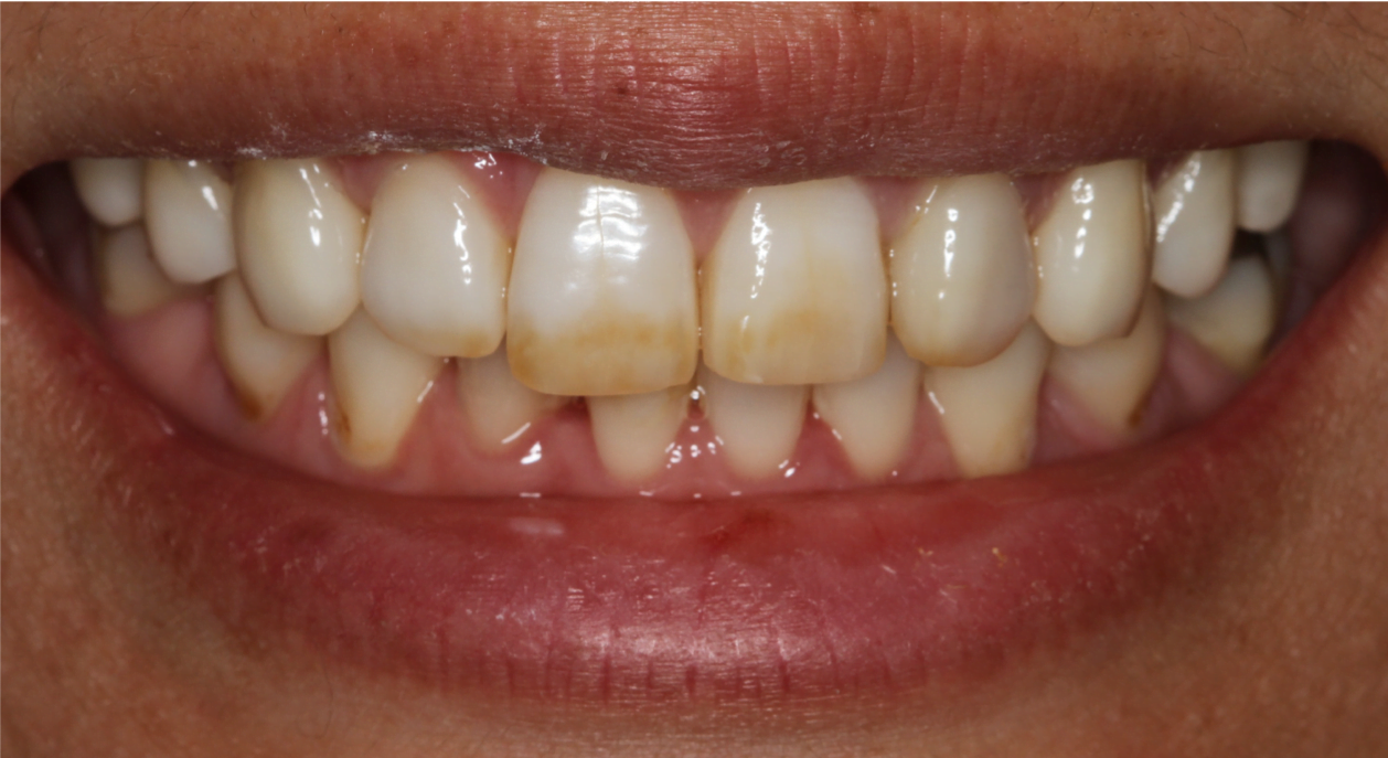 Enlighten Enhanced Whitening