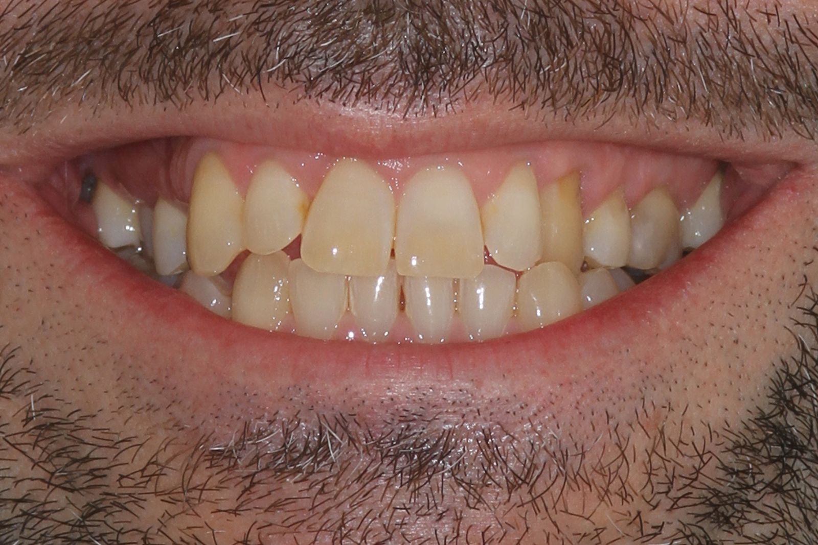 lingual orthodontics composite bonding teeth whitening