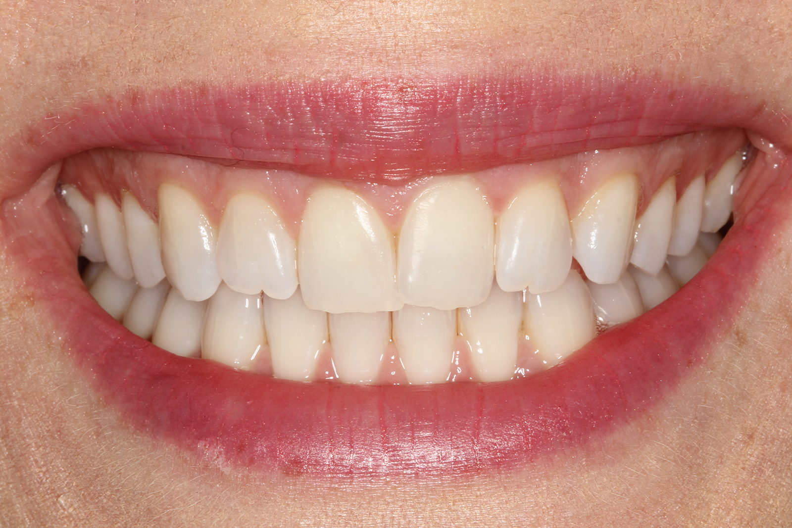 enlighten, microabrasion & resin infiltration after