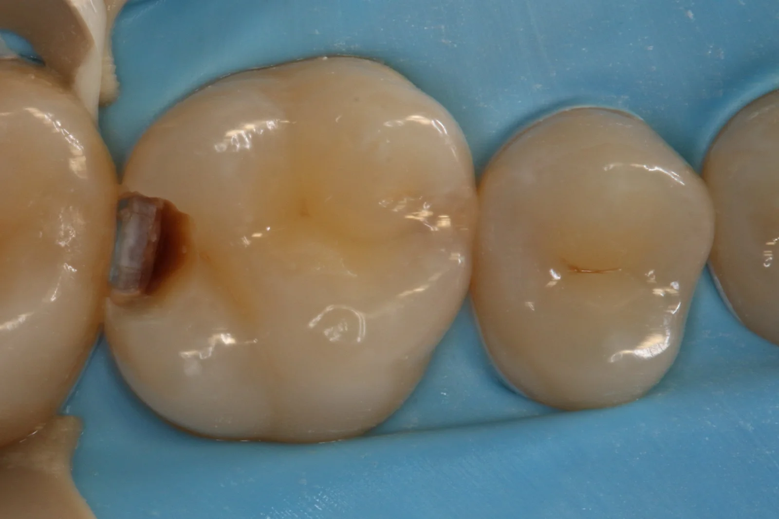 molar composite filling