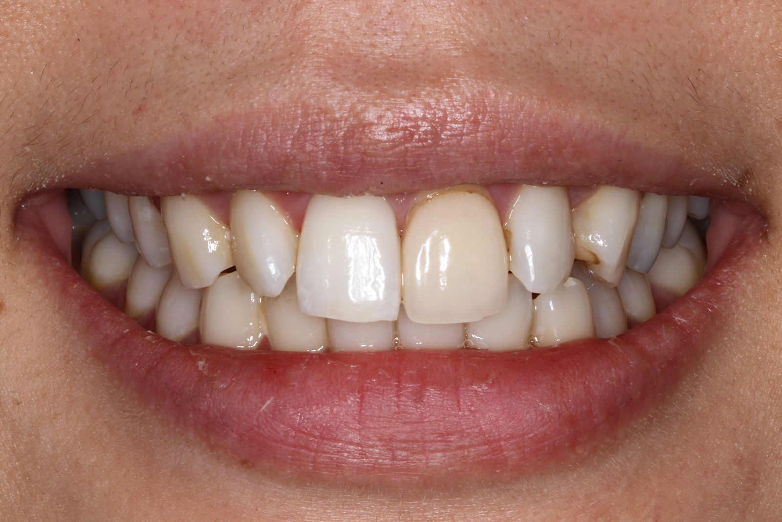 Single veneer change