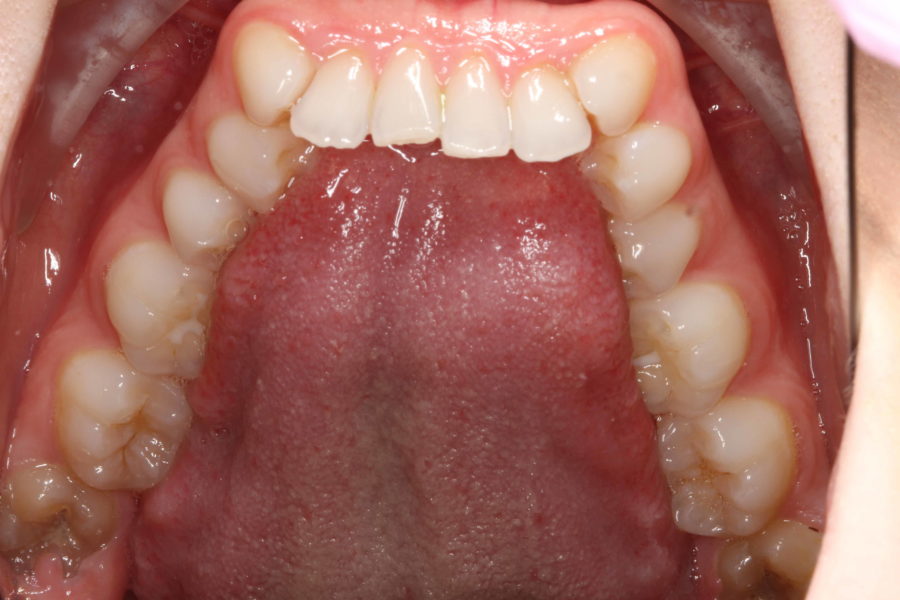 Initial Lower occlusal Smile Makeover Before