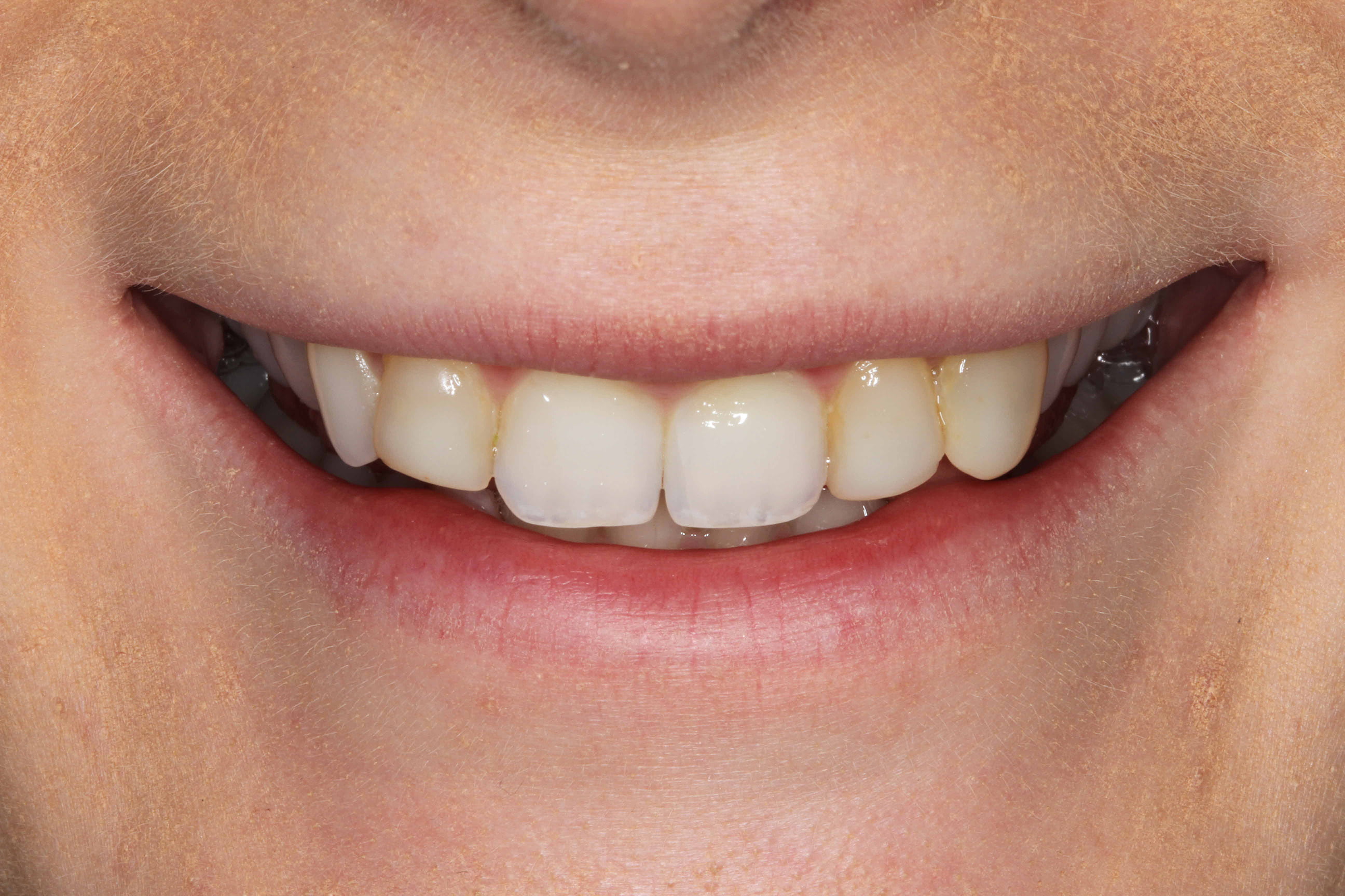 smile makeover before