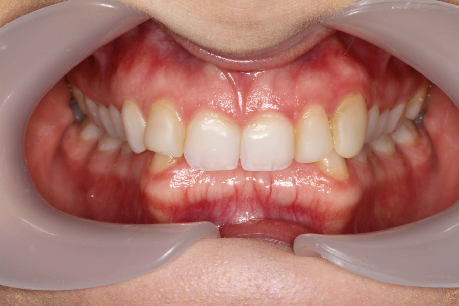Initial Retracted Front Closed Smile Makeover