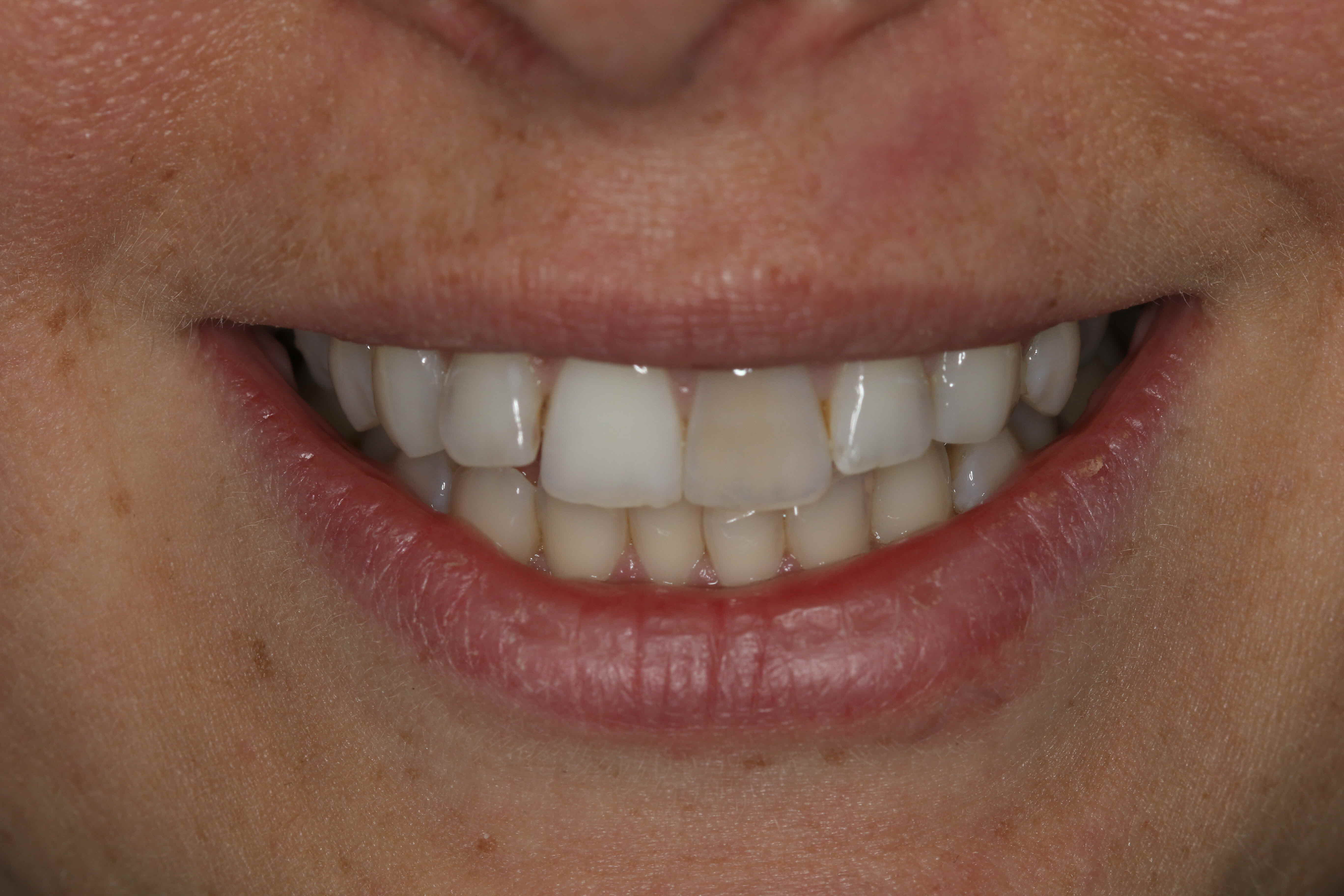 tooth whitening results