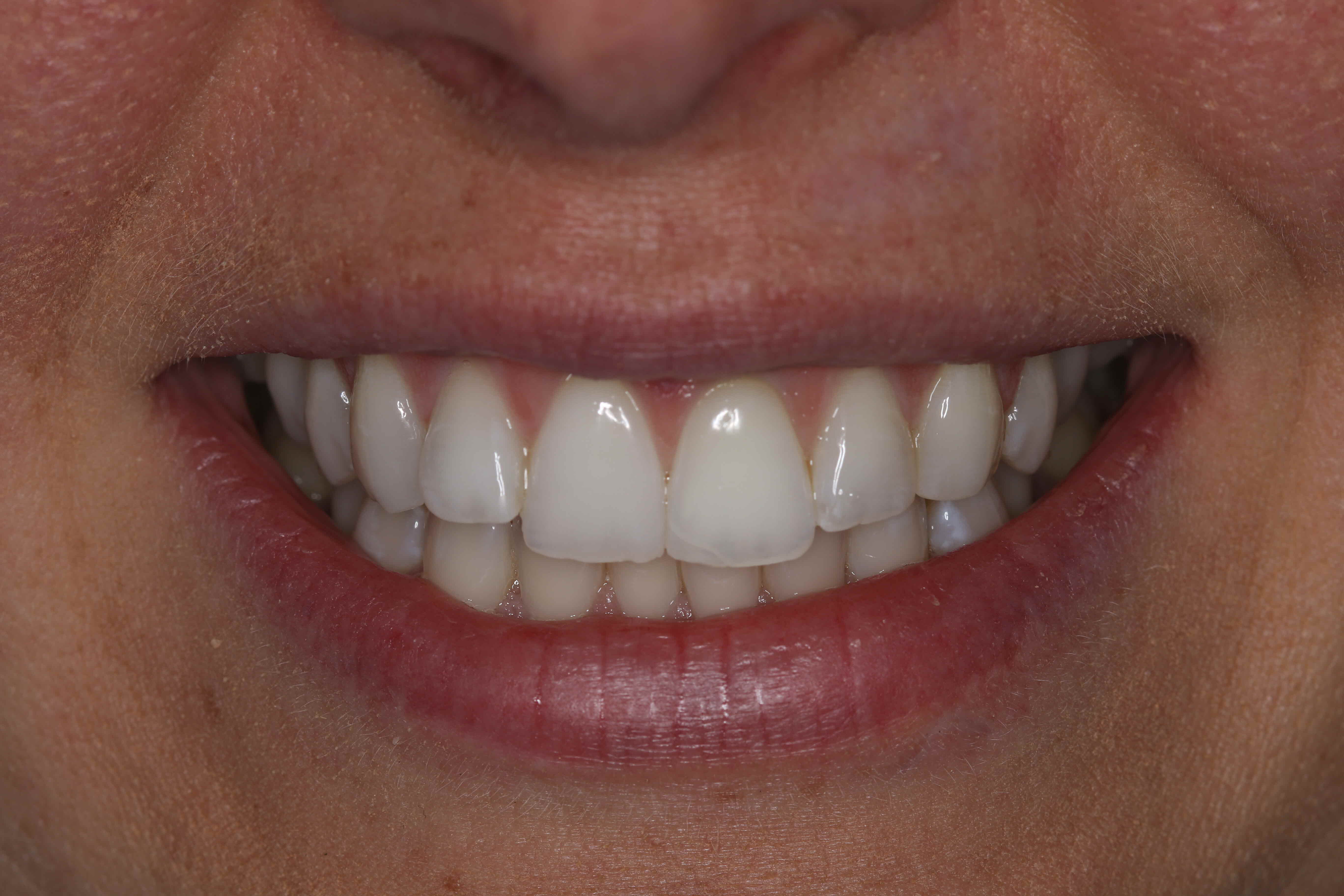tooth whitening results