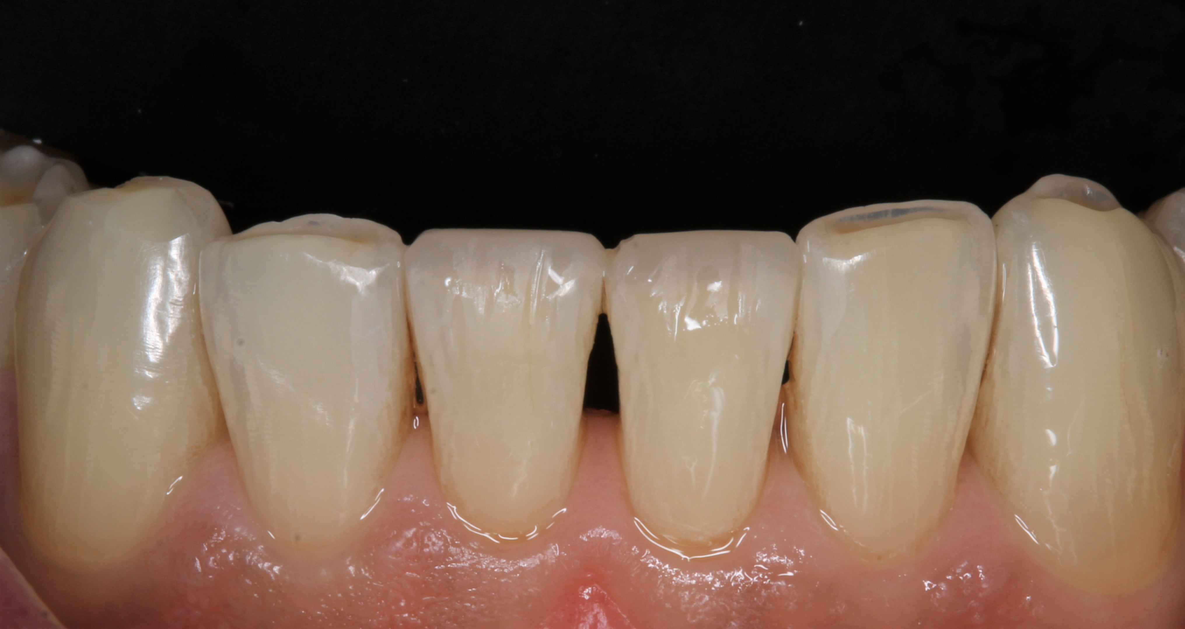 composite bonding after