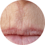 Fine Lip Lines Fine Lip Lines