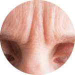 Glabellar Lines Facial Aesthetics Botox Glabellar Lines