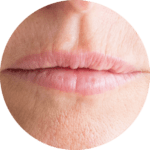 Lip Fullness Facial Aesthetics Lip Fullness