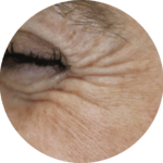 crows feet crows feet