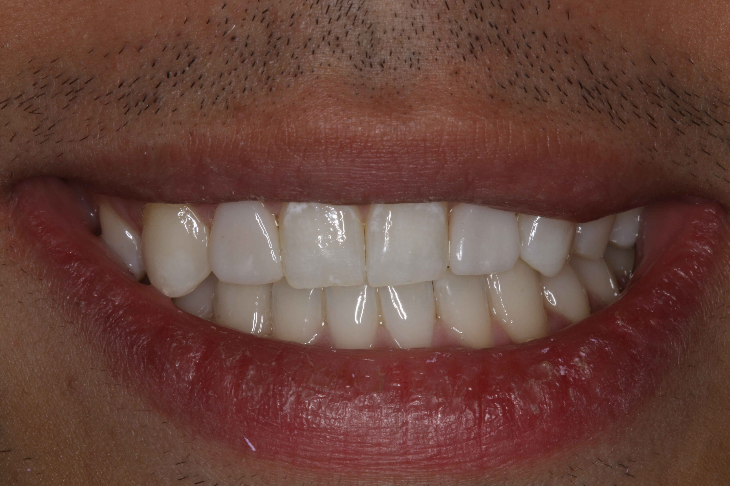 Teeth Whitening & Composite Bonding Willow Tree Dental
