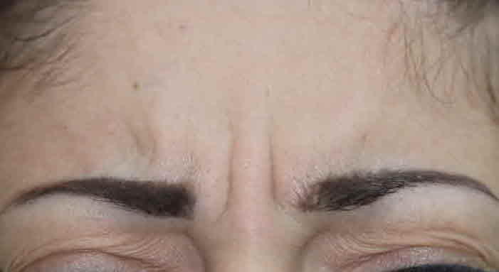 frown line botox before