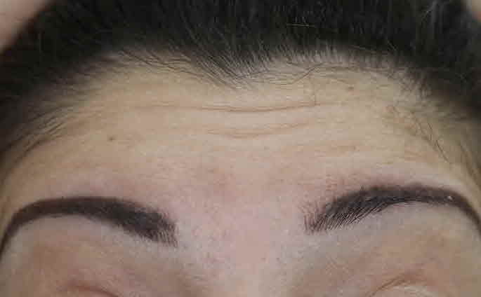 forehead botox