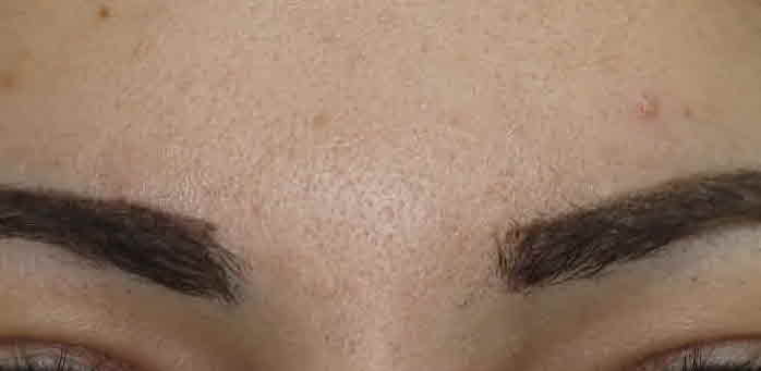 frown line botox after