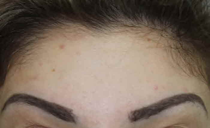 forehead botox after