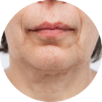 jowls skin boosters for jowls