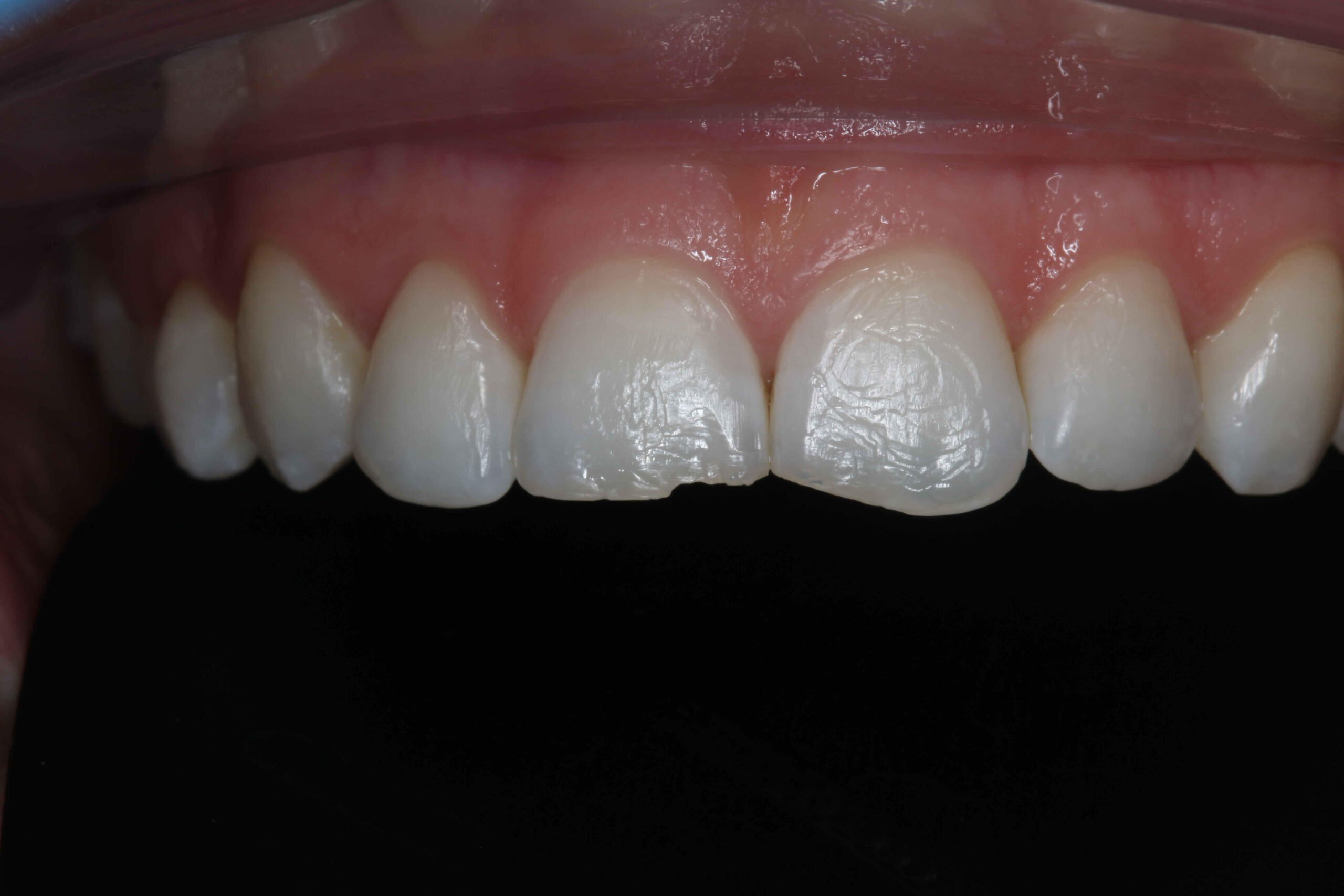 align, bleach and composite bonding